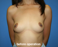 plastic-surgery-breast-augmentation